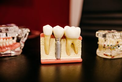 Zahnarztpraxis in München, Implantatprothetik